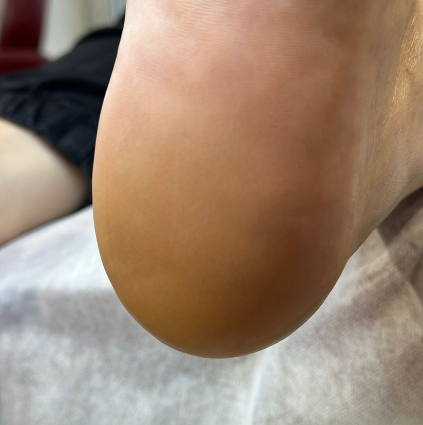 Подологическая обработка стопы 1 категории