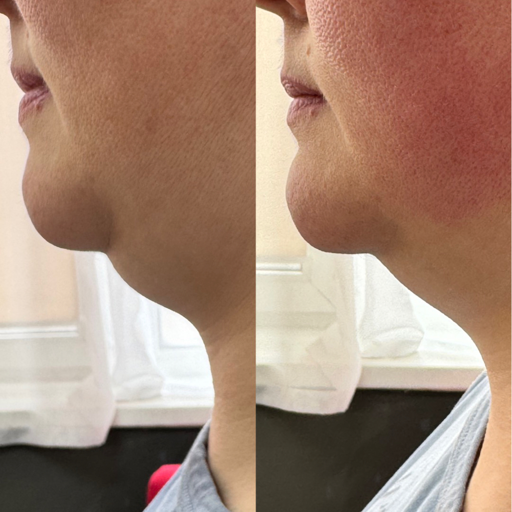 ХОЛОДНАЯ ПЛАЗМА Жиросжигание подбородок