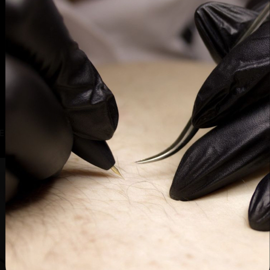 «Электроэпиляция» Бикини (только лобок)‼️Анестезия оплачивается отдельно  400₽  *мин 75₽  Сумма указана за 120 минут