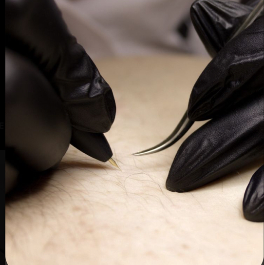 «Электроэпиляция» на лице, соски, белая дорожка живота