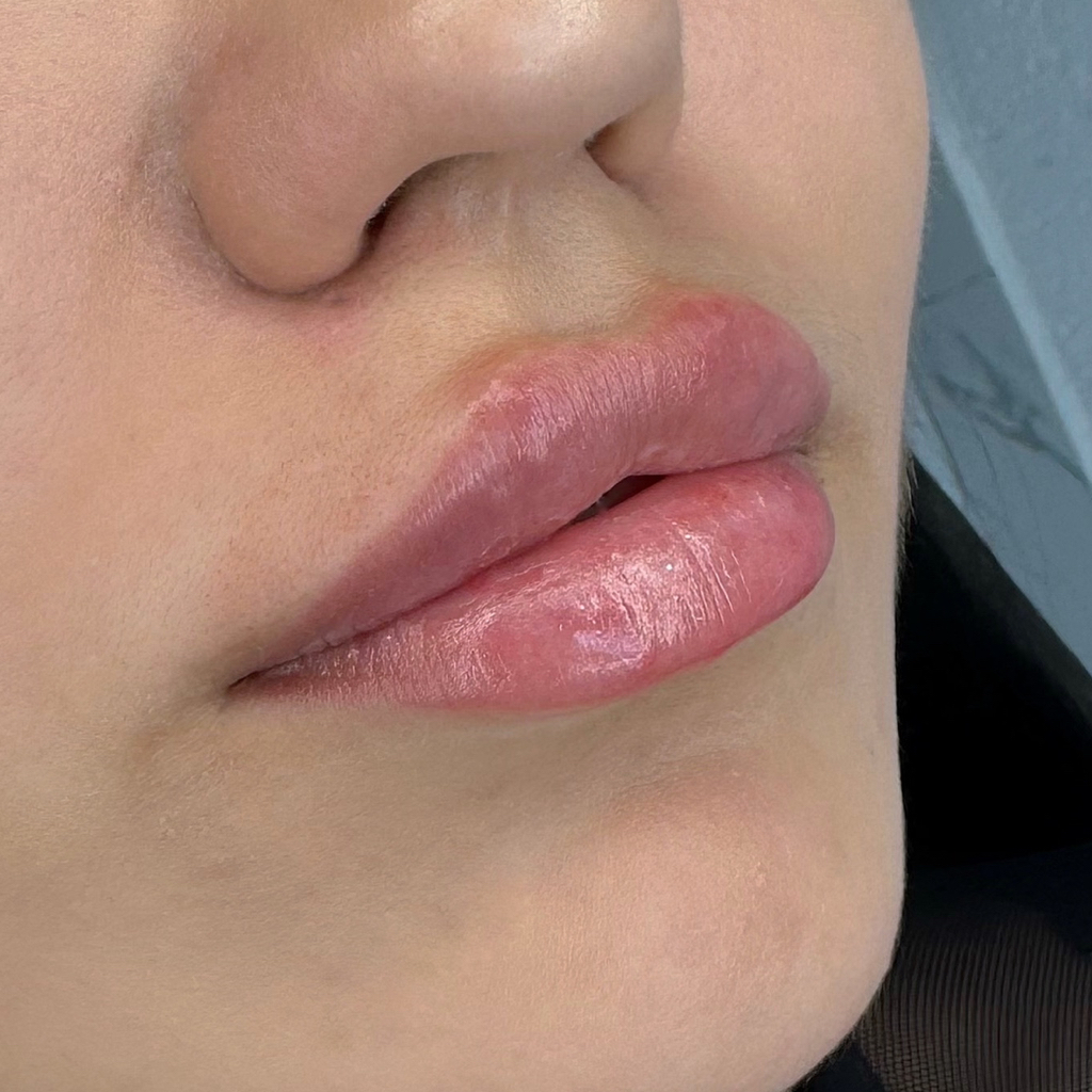 Увеличение губ