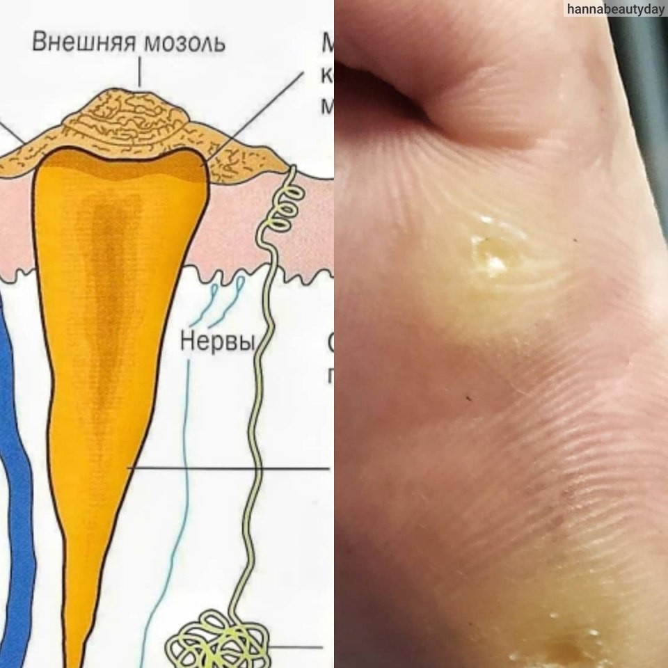 стержневая мозоль