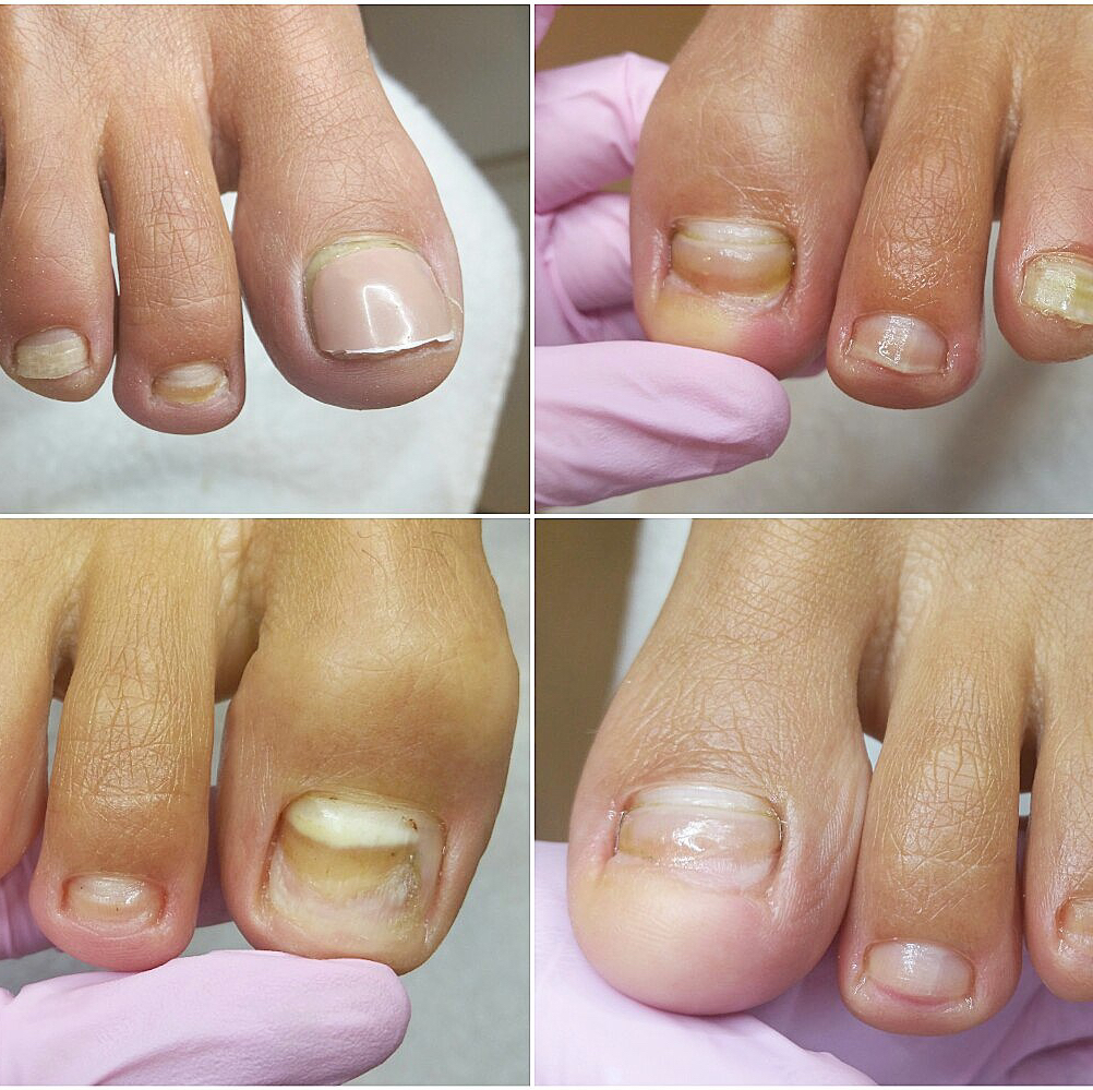 Подологический педикюр (зачистка онихолизиса)