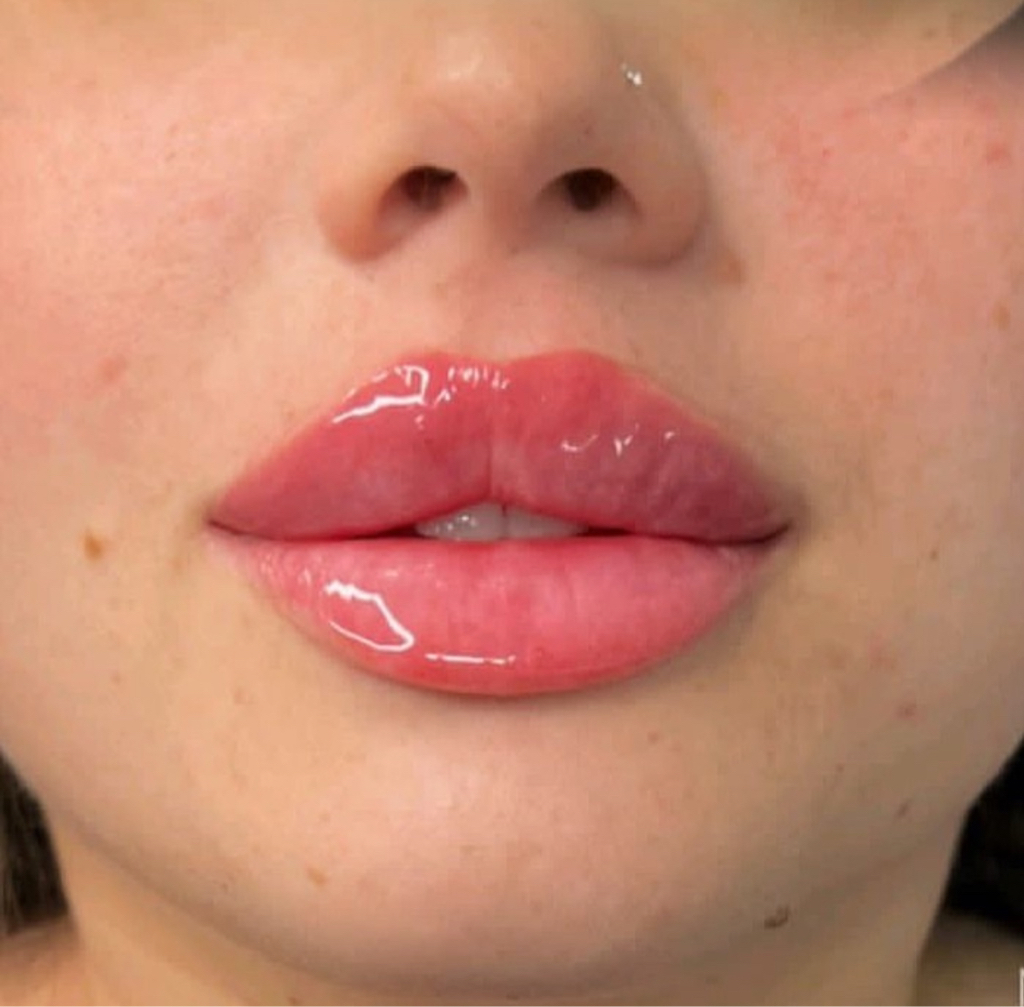 Aumento de labios