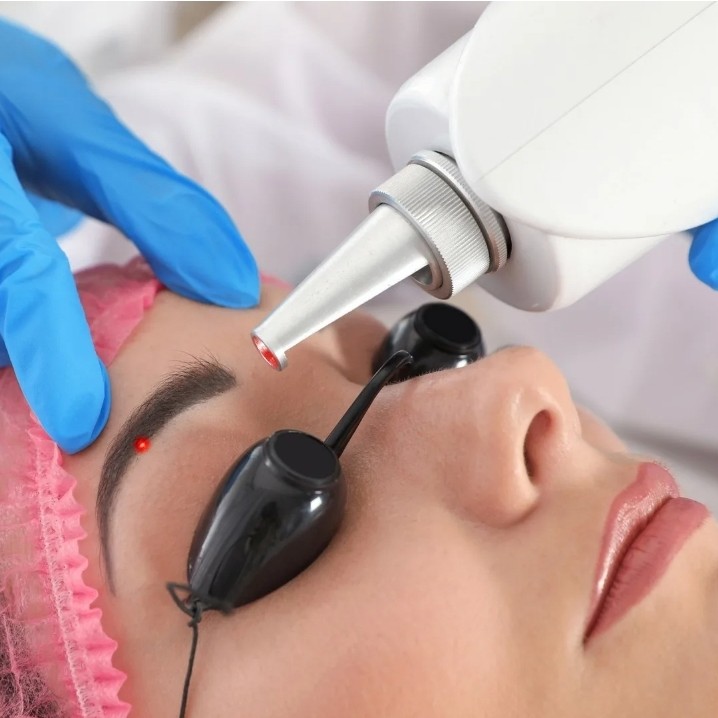 Сведение татуажа.Лазер.