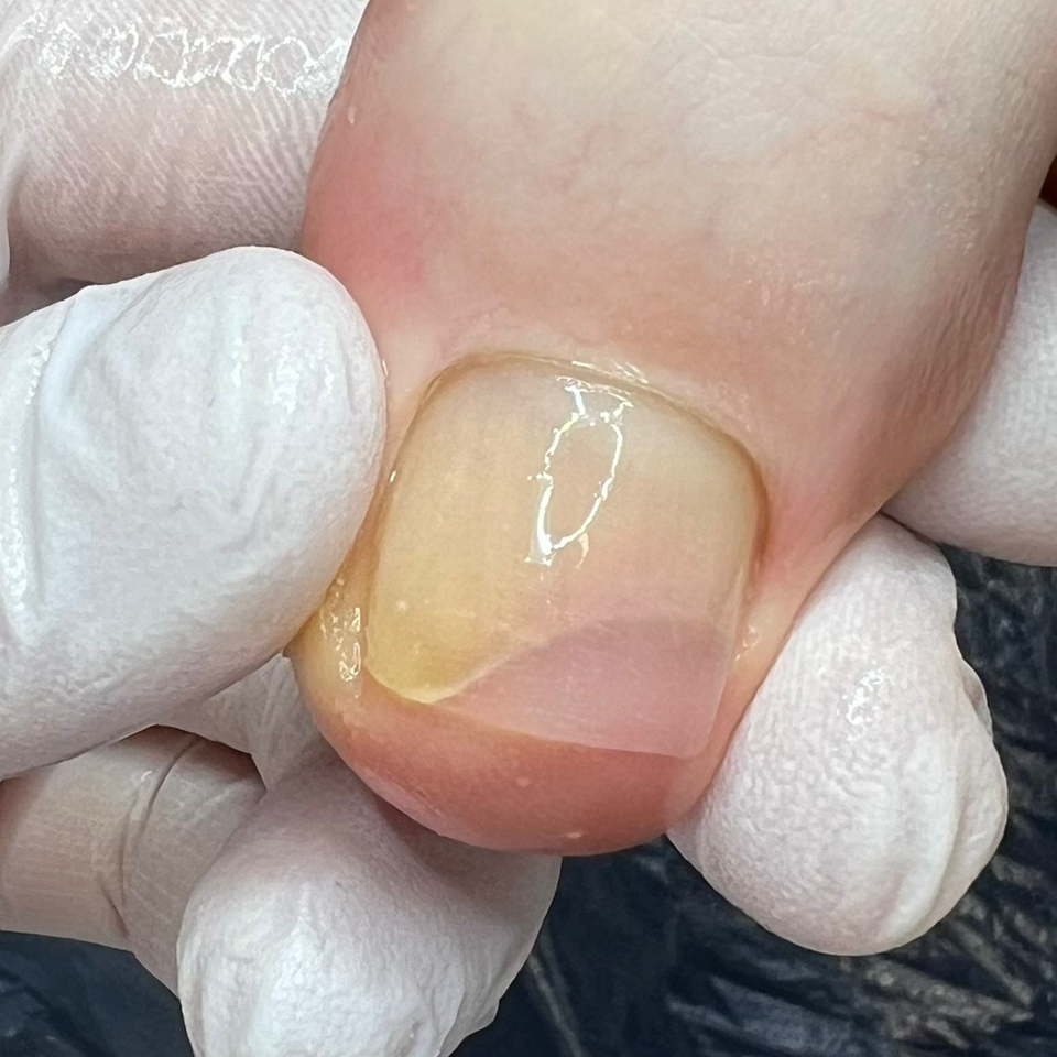 Протезирование