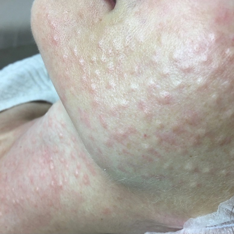 Мезотерапия