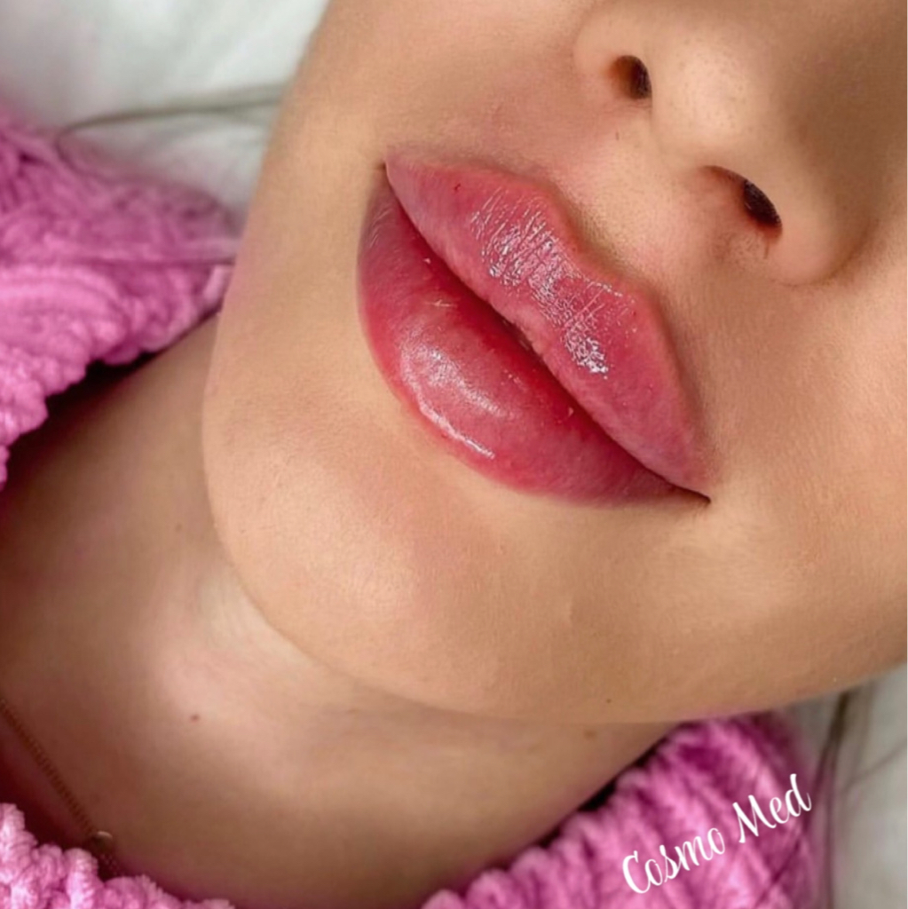 Контурная пластика губ