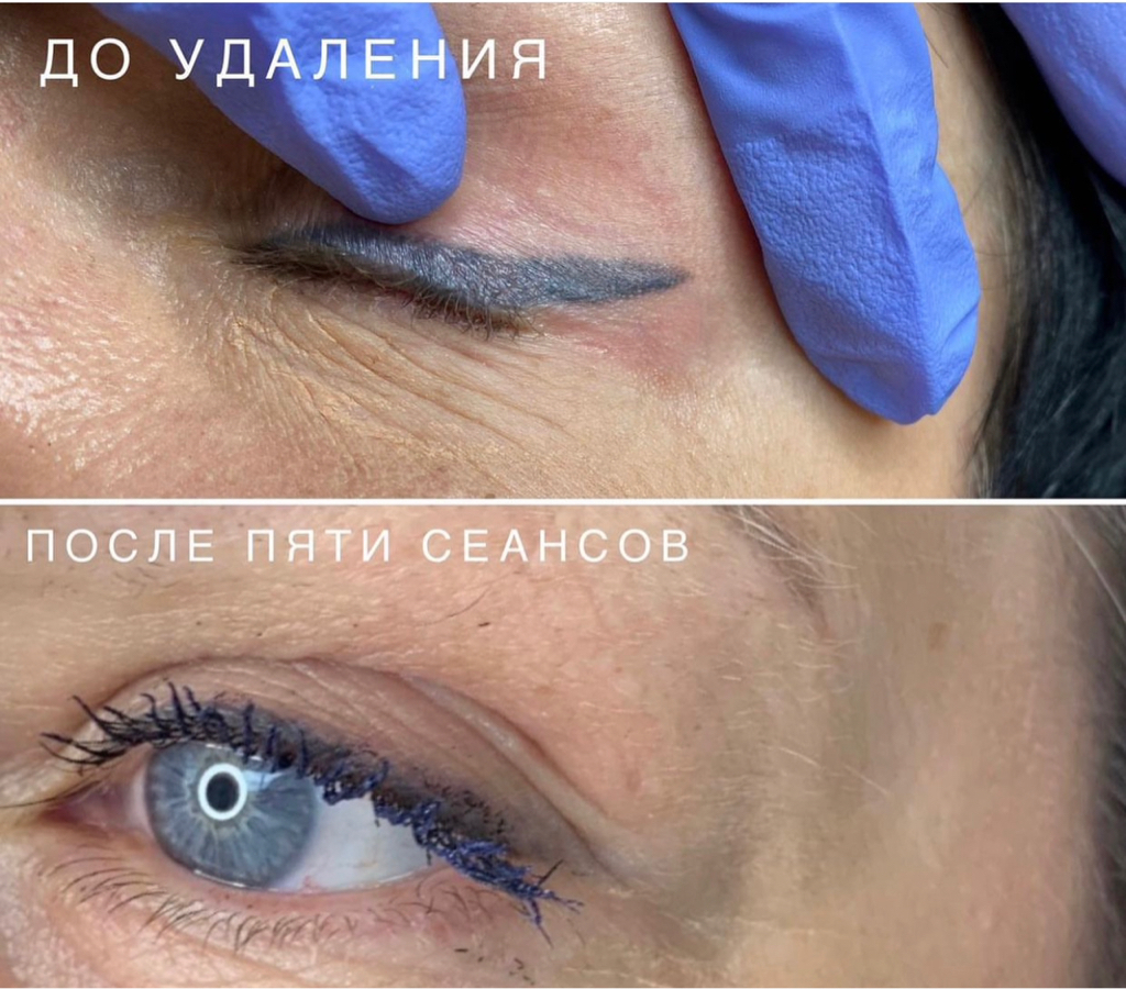 Удаление татуажа век (лазер)