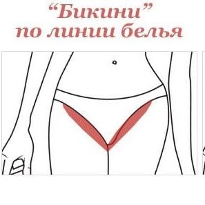 Лазерная эпиляция Бикини классическое