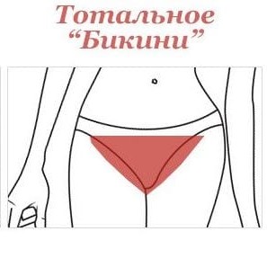 Лазерная эпиляция Бикини тотальное