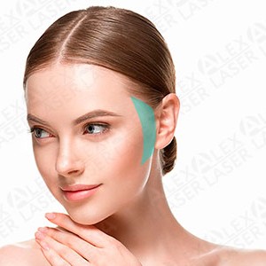 Лазерная эпиляция Виски