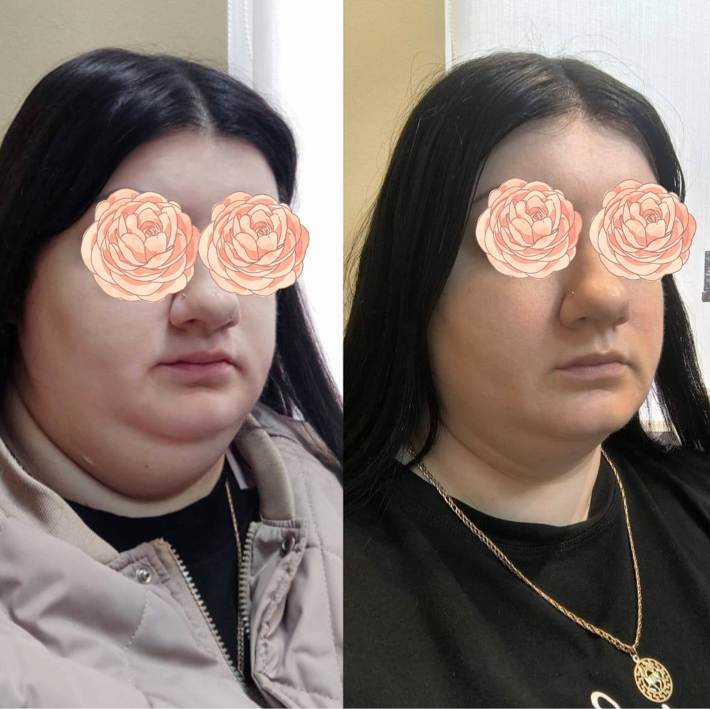 Худое лицо ( пептидный)