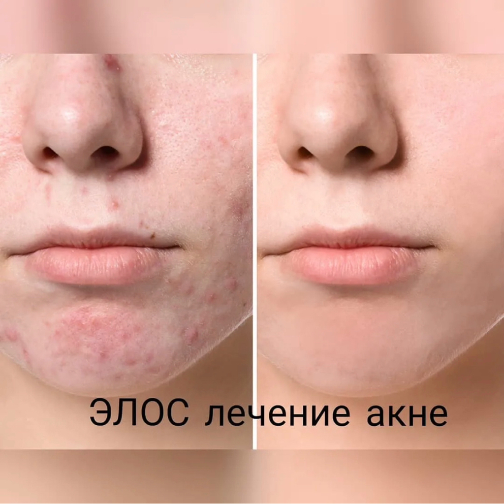 ЭЛОС-Лечение акне на лице