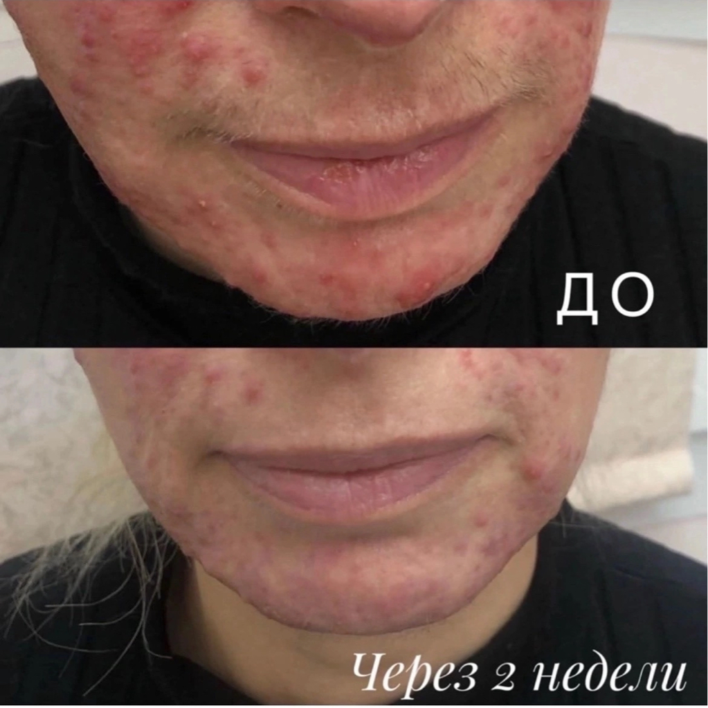 ЭЛОС-Лечение розацеа