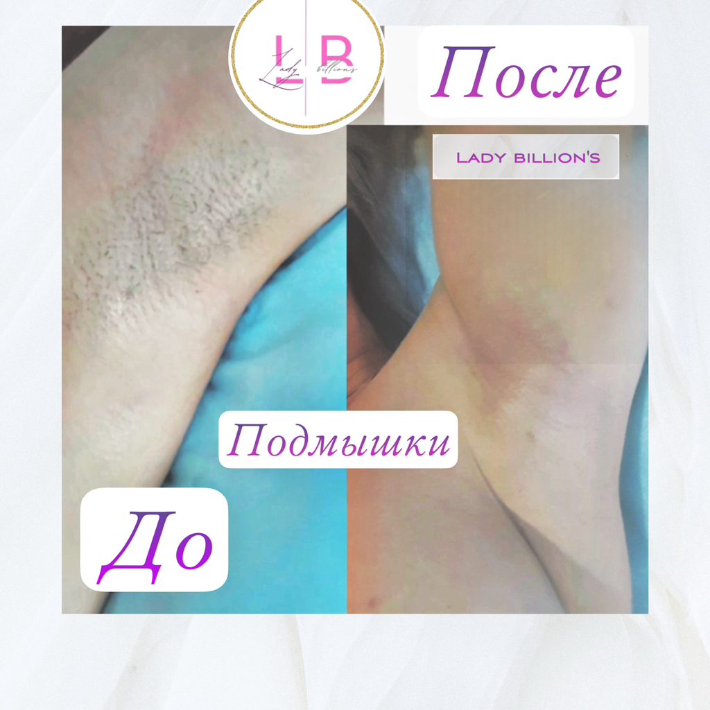 Депиляция Подмышки
