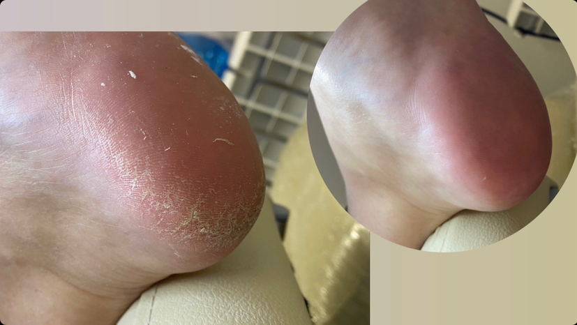 Обработка стопы