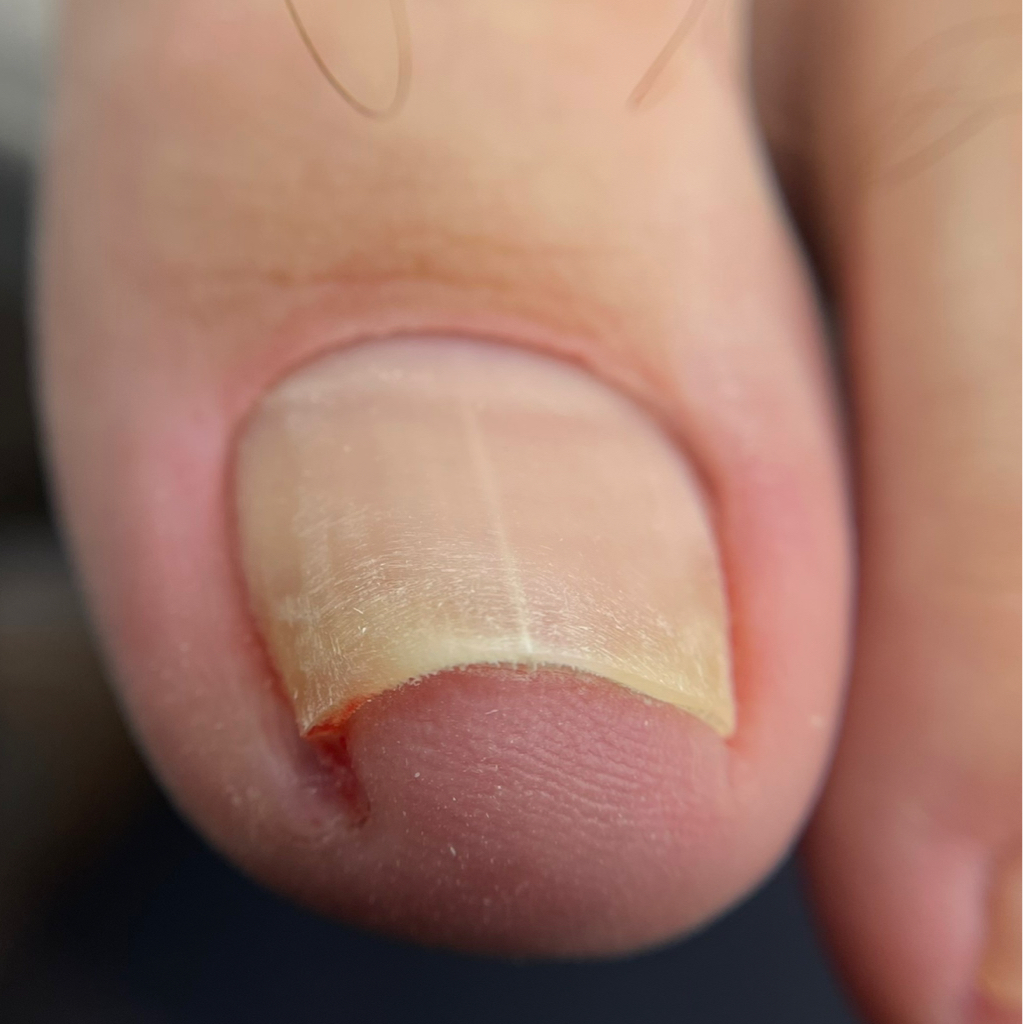 Педикюр мужской без стопы