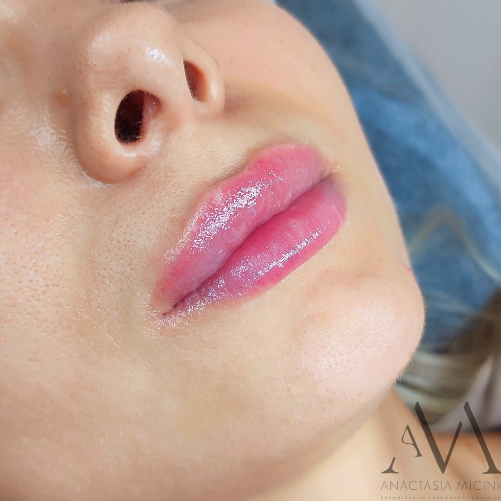 Увлажнение губ без иглы