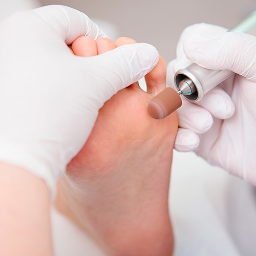 Аппаратная гигиеническая обработка кожи стоп и ногтевых пластин