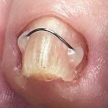 Установка титановой нити 1 маленький ноготь