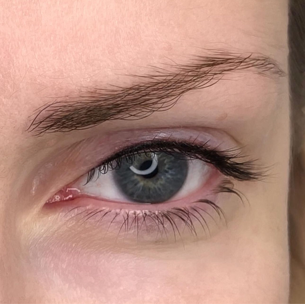 Коррекция ПМ межресничка