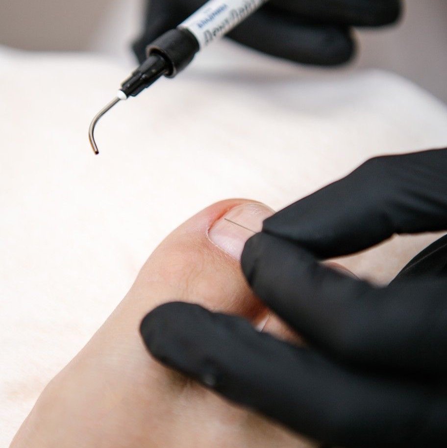 Установка коррекционной системы (титановая нить)