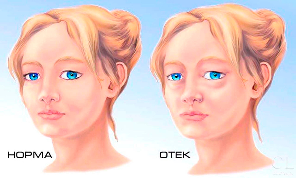 Ликвидатор отеков