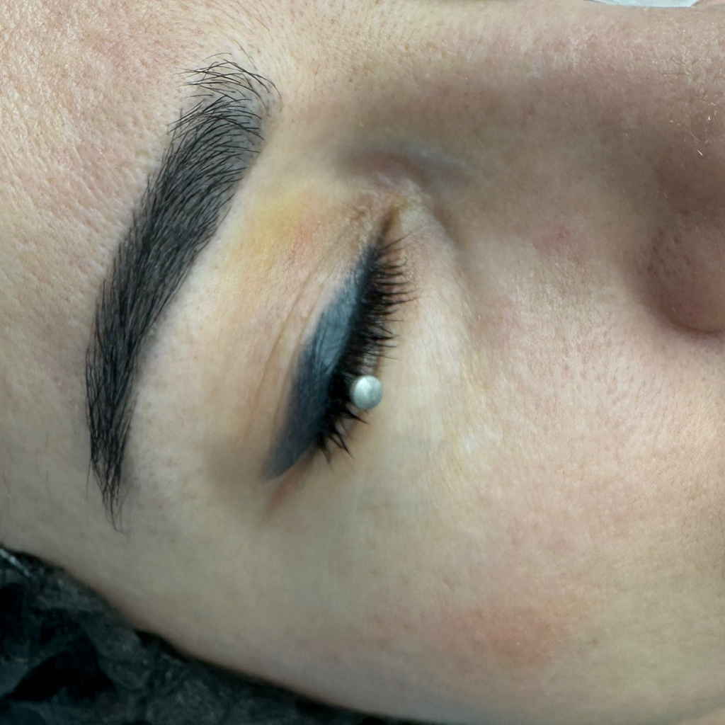 Лазерное удаление татуажа век