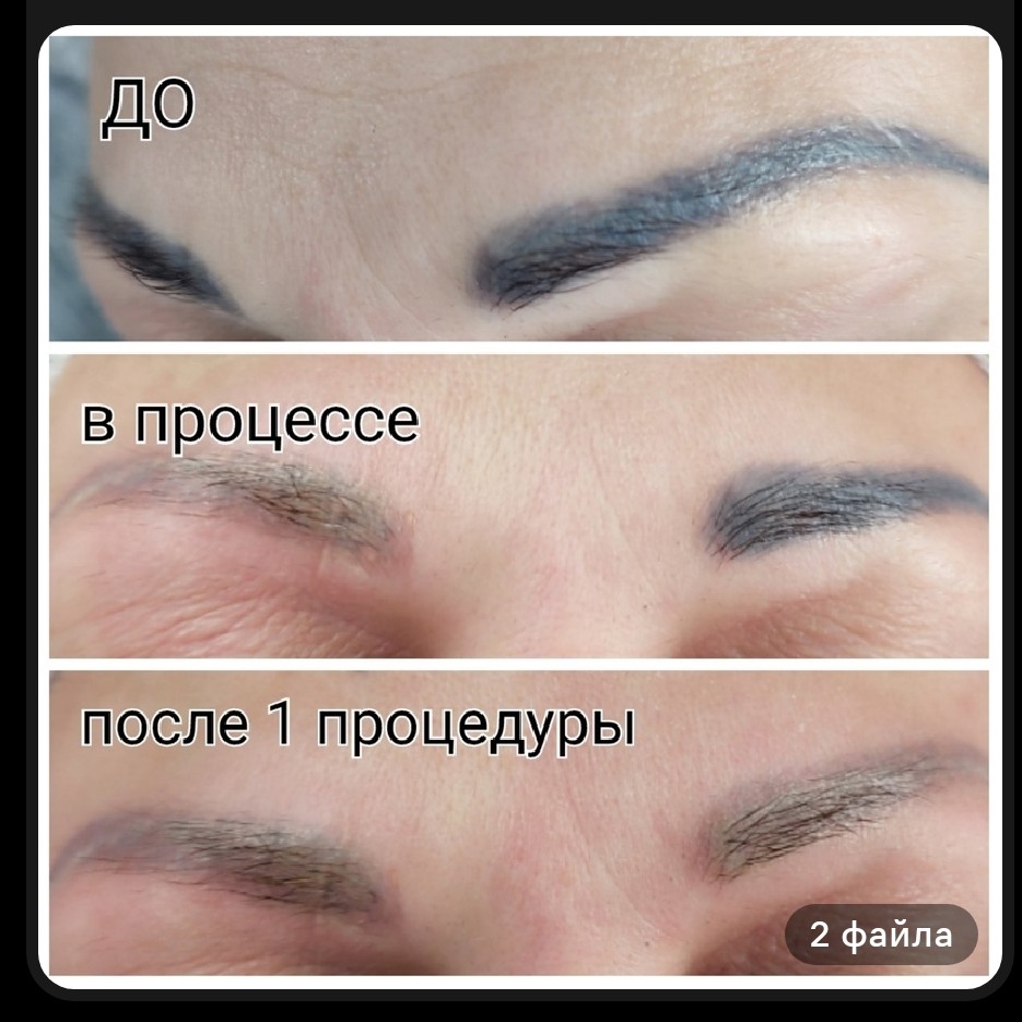 Лазерное удаление татуажа губ