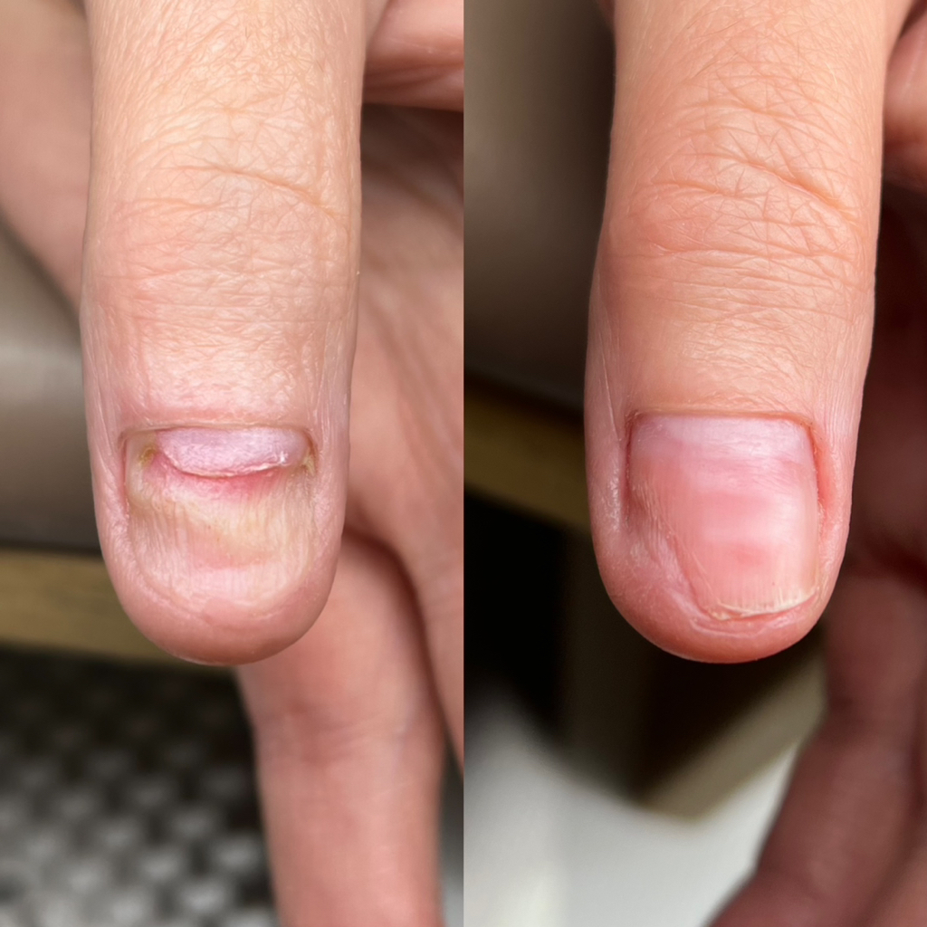 ЗАЧИСТКА ОНИХОЛИЗИСА