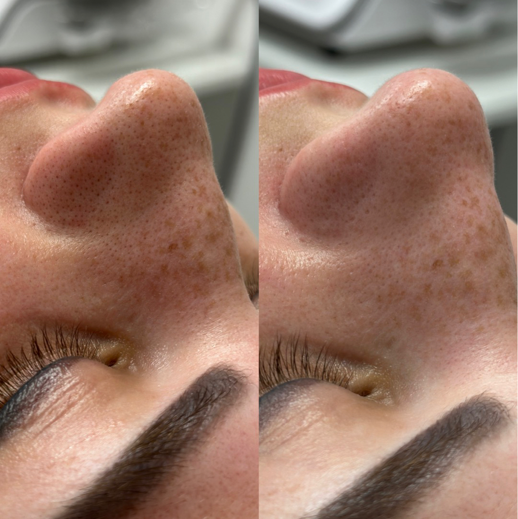 Комбинированная чистка лица