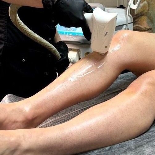 лазерная эпиляция голени