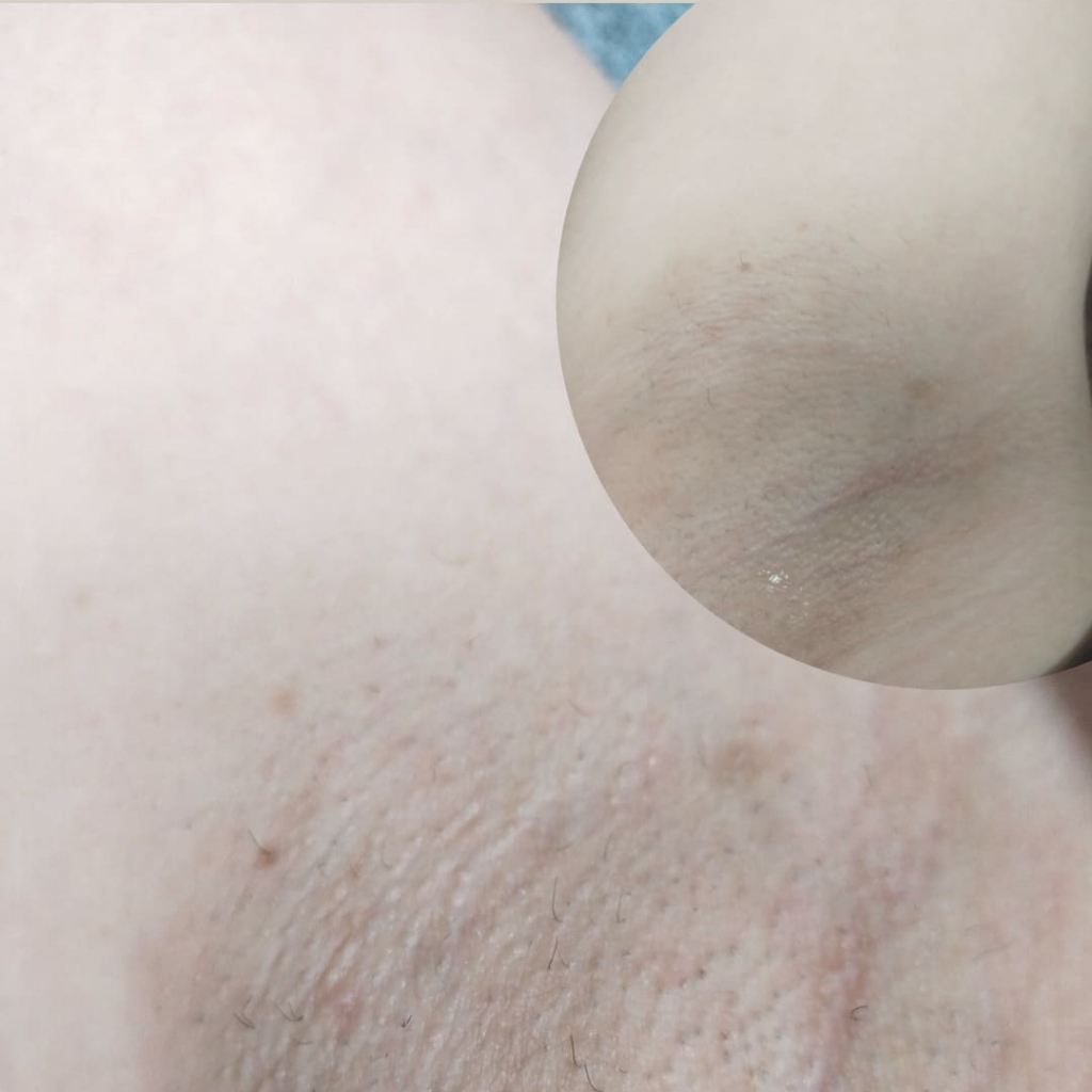 отбеливание подмышек