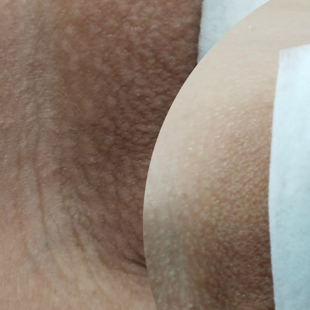 интимное отбеливание