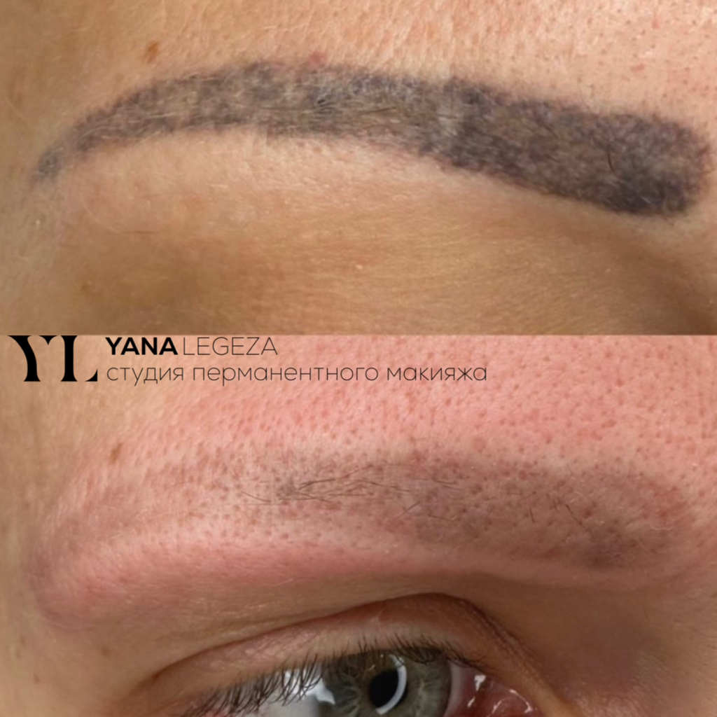 Лазерное удаление татуажа