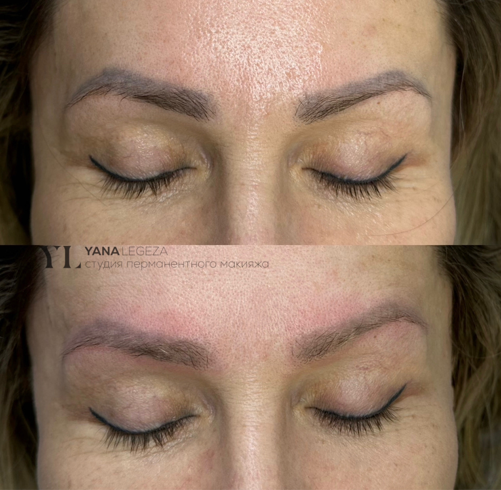 Удаление татуажа ремувером