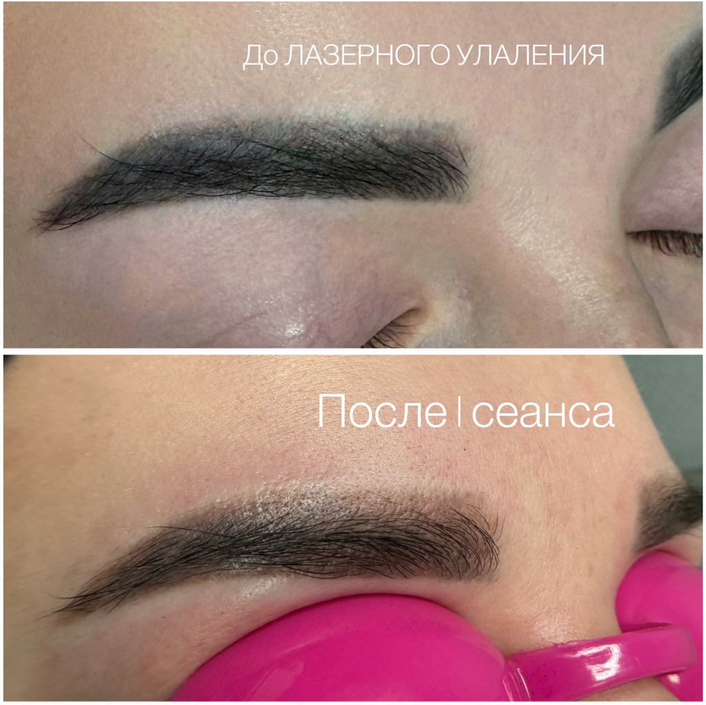 Удаление лазером татуажа ( зона брови/губы )