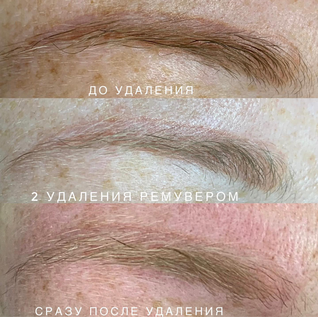 Удаление ремувером