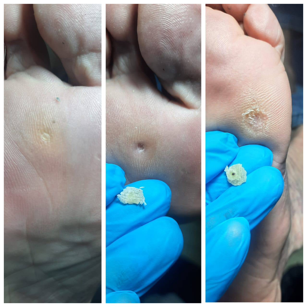 Удаление стержневой мозоли