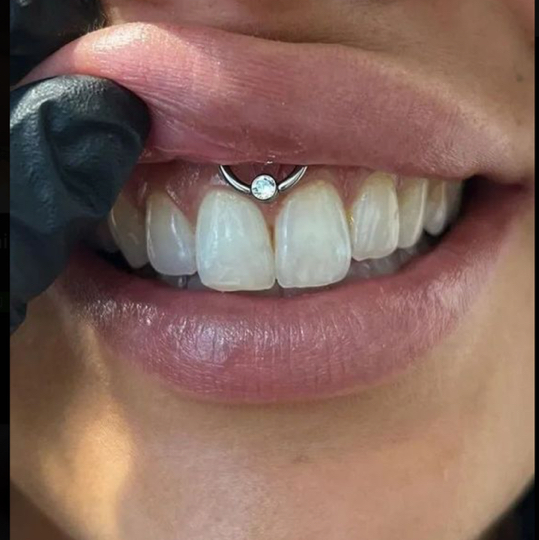 Пирсинг уздечки (смайл/антисмайл)