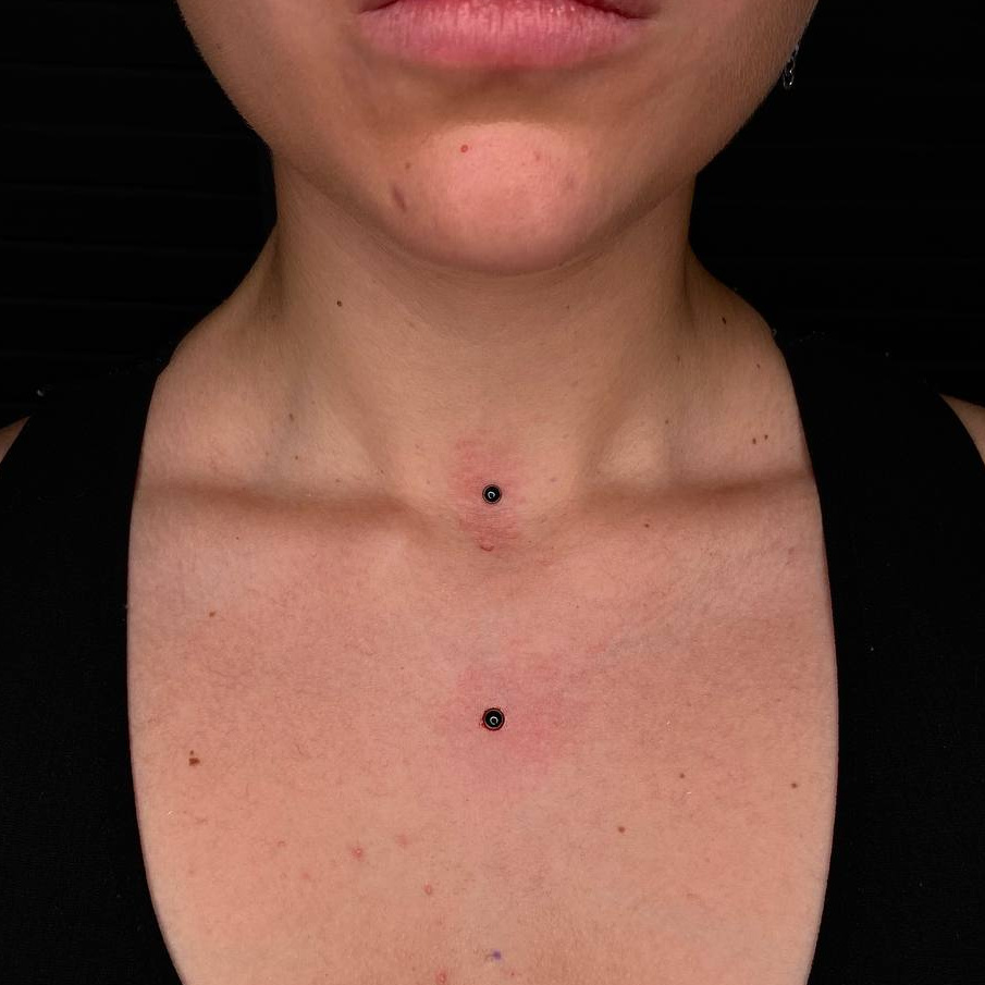 Установка микродермала