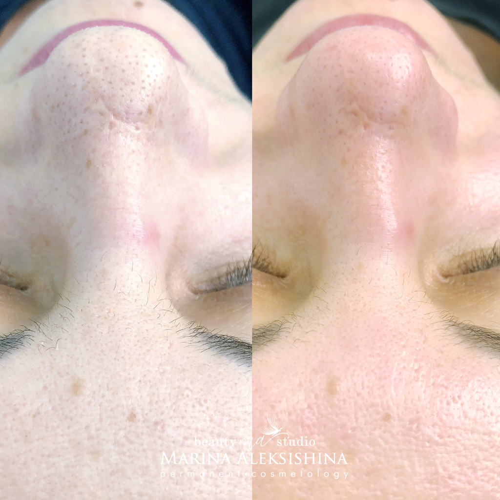 Чистка лица+энзимный пилинг