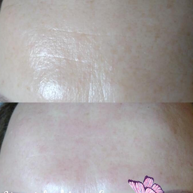 Аппаратная мезотерапия