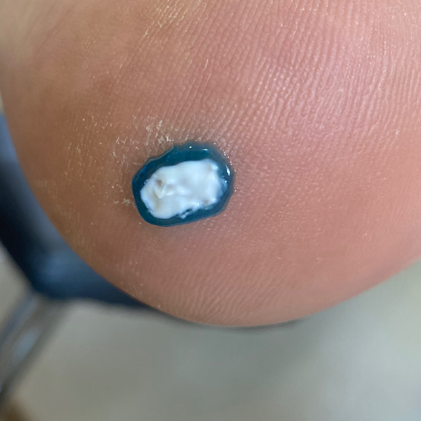 Удаление бородавки за 1 шт.