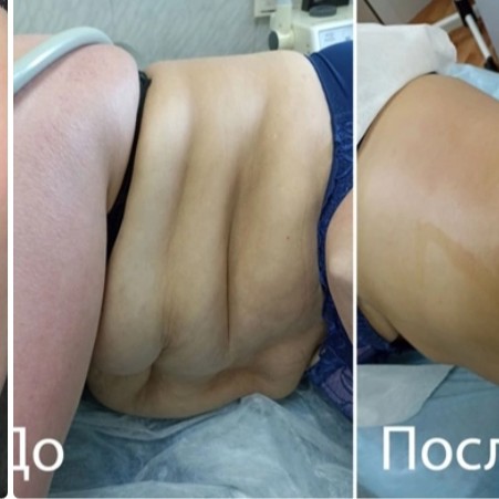 Живота круговая подтяжка