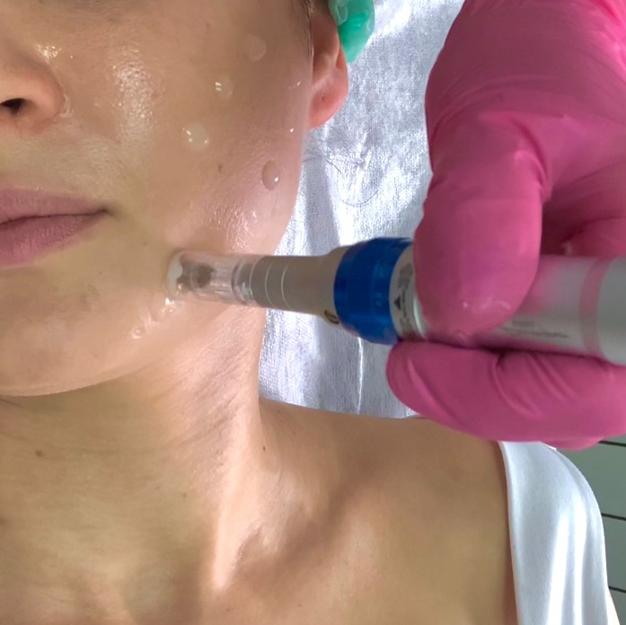 МАССАЖ + ДЕРМАПЕН 4500₽ вместо 6200₽