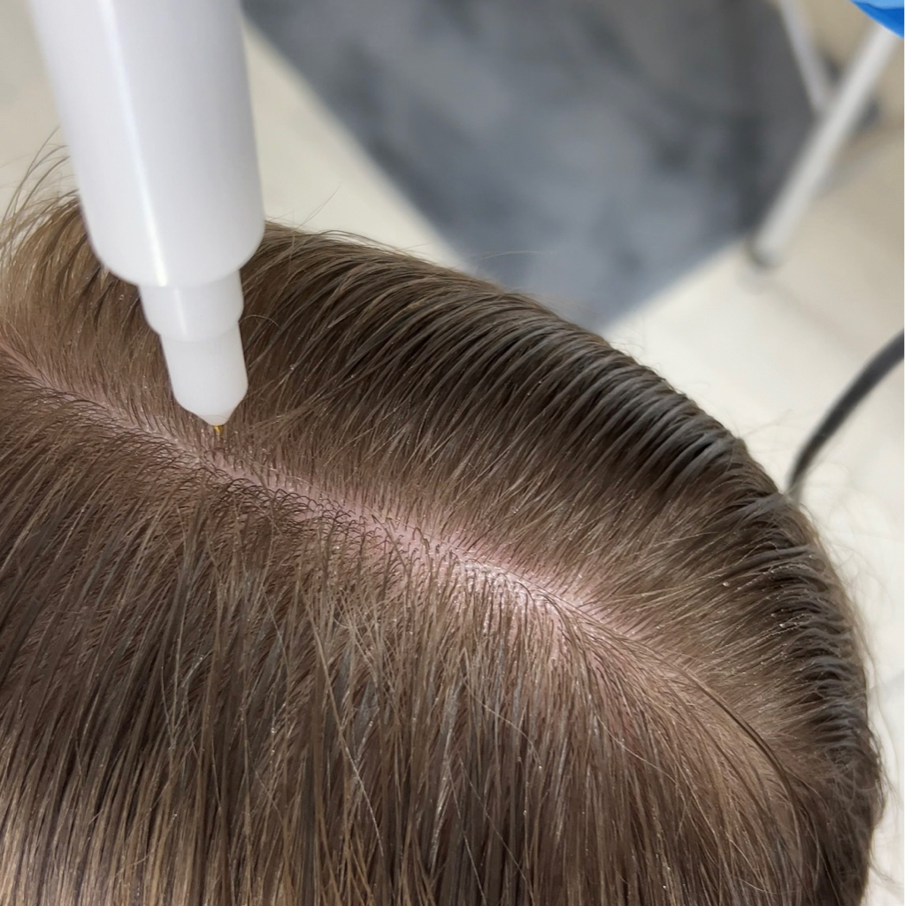 Холодная плазма  Обработка кожи головы