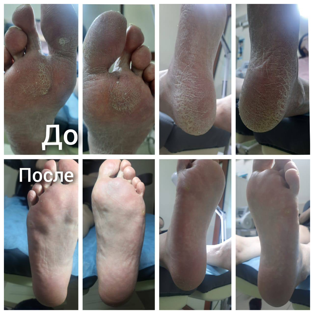 Обработка стоп с гиперкератозом/трещинами