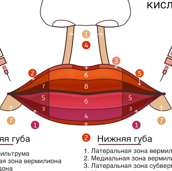 Убрать миграцию  филлера над верхней губой лонгидаза